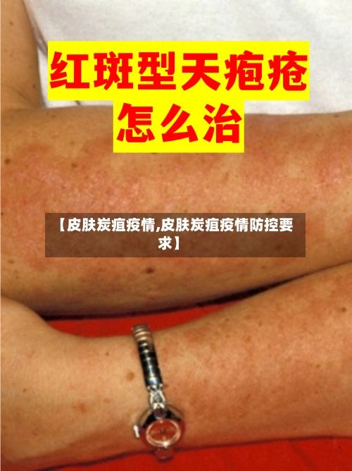 【皮肤炭疽疫情,皮肤炭疽疫情防控要求】-第2张图片